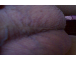 精索靜脈曲張圖片介紹